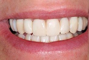 Before and After Dental Implants in Old Saybrook