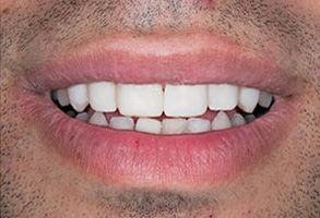 Before and After Teeth Whitening in Old Saybrook