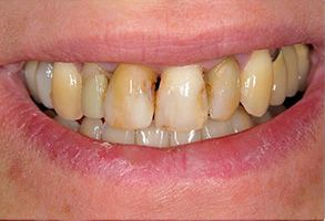 Old Saybrook Before and After Dental Implants