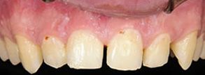 Before and After Dental Fillings 06475