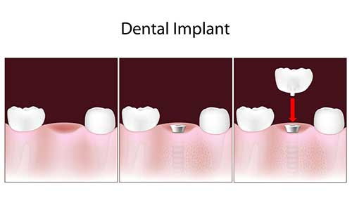 dental implants in Old Saybrook