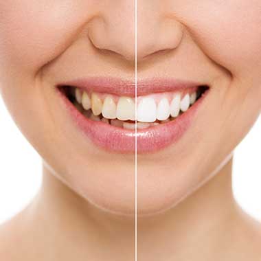 Teeth Whitening in Old Saybrook