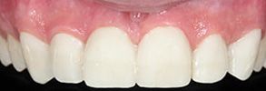 06475 Before and After Dental Fillings