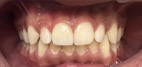 Old Saybrook Before and After Invisalign