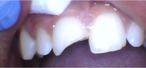 Old Saybrook Before and After Invisalign